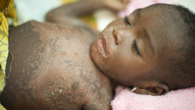 Photo of 10 cases of measles recorded in Ketu South