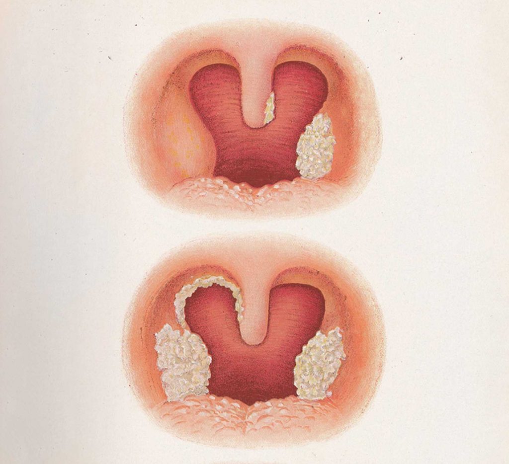 diphtheria